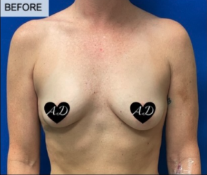 Breast Augmentation